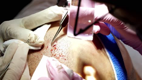 médicos que recolectan folículos pilosos de la barba para luego implantarlos en el cuero cabelludo, extracción de unidades foliculares