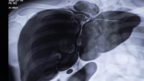 a medical examination shows significant lung irregularities in a patient through detailed imaging techniques.