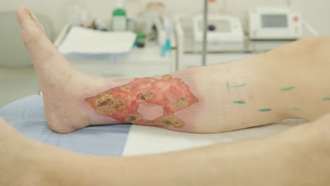 herida de úlcera en la pierna en el tratamiento de venas varicosas en el procedimiento de flebología. unión de venas con pegamento biológico