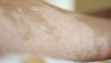 close-up of vitiligo on human skin