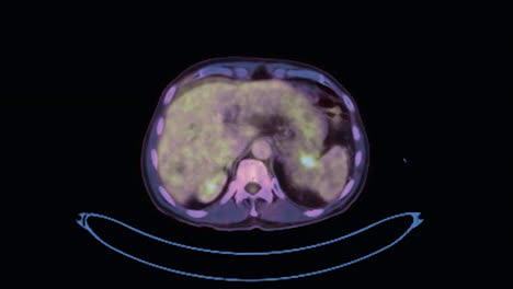 pet ct ( positron emission tomography )  of whole human body 3d rendering image axial view for detect tumor recurrence after surgery.