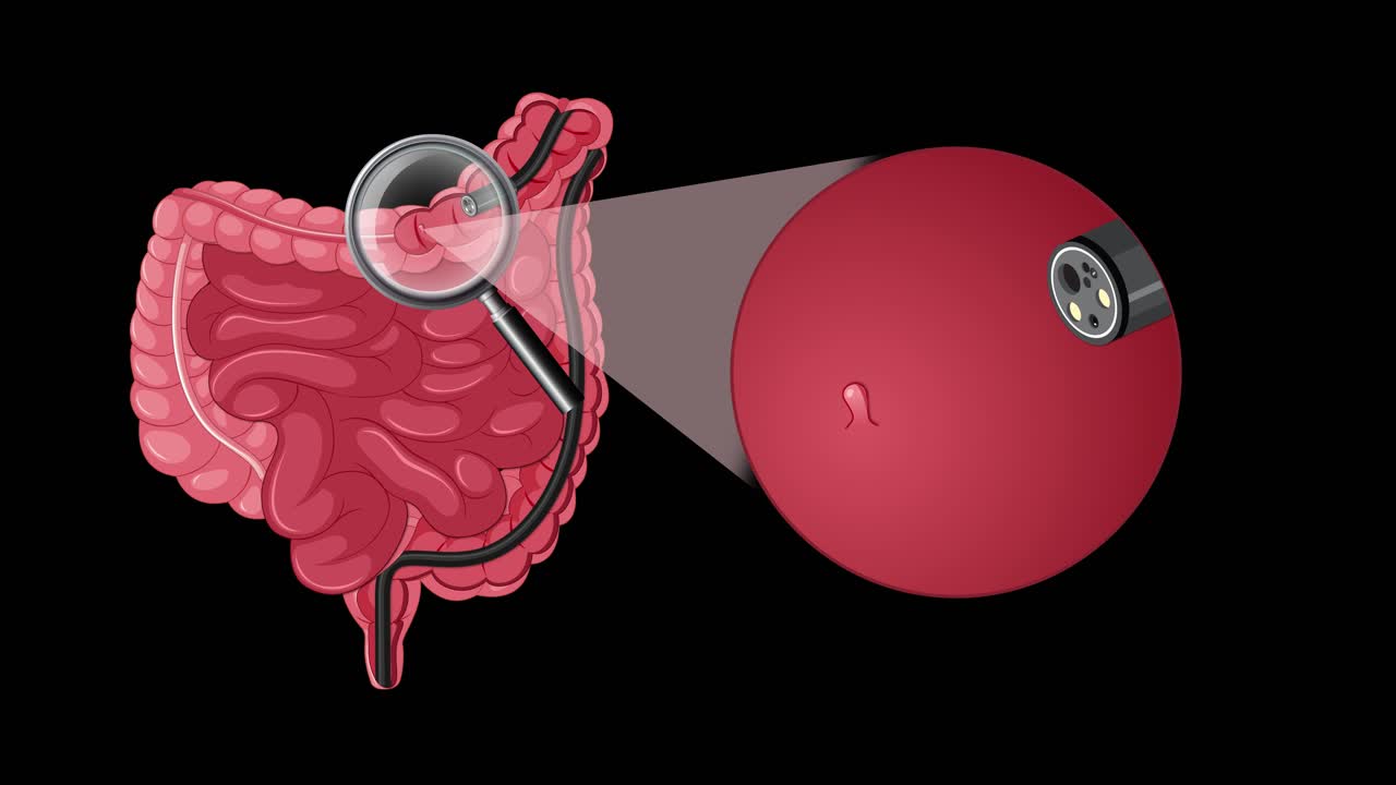 Medical animation showing endoscopic polyp removal from colon using minimally invasive surgical technique