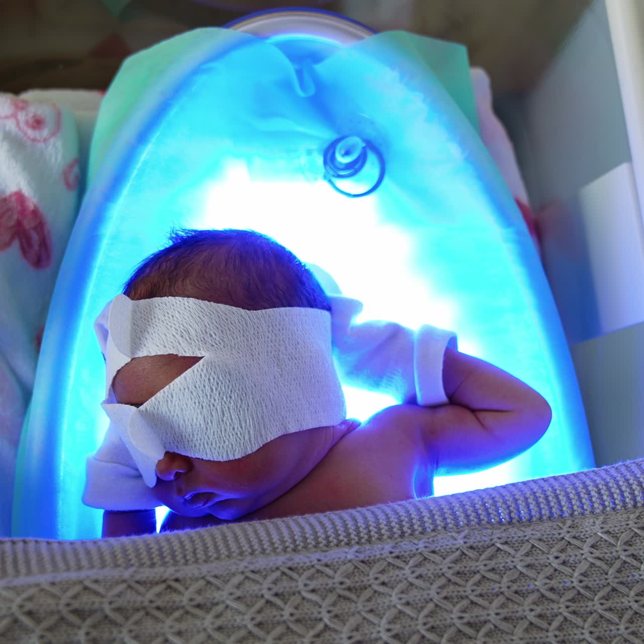 Little baby with bandage on eyes sleeps on the UV lamp. High bilirubin treatment in the maternal hospital. Top view