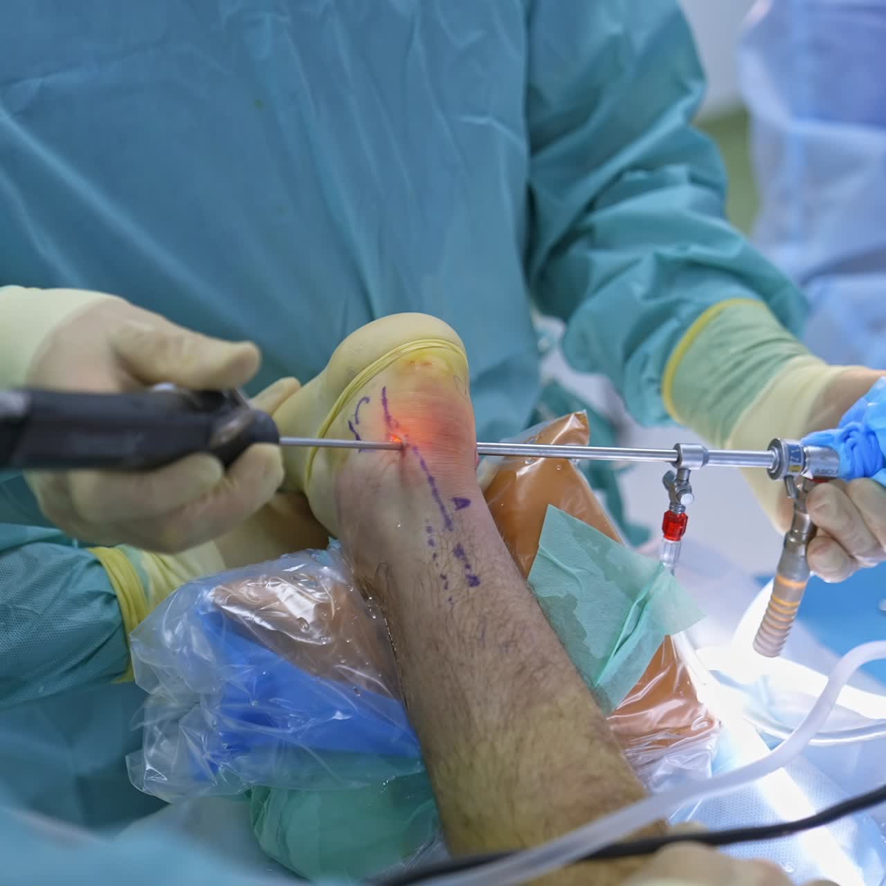 Surgeon with laparoscopic instruments