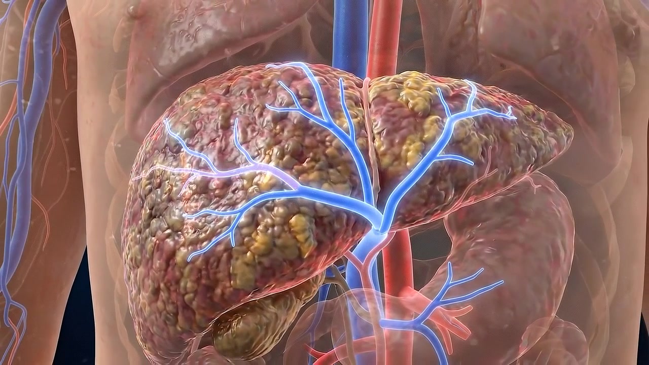 3D Medical Animation of Human Liver Cirrhosis and Vascular System