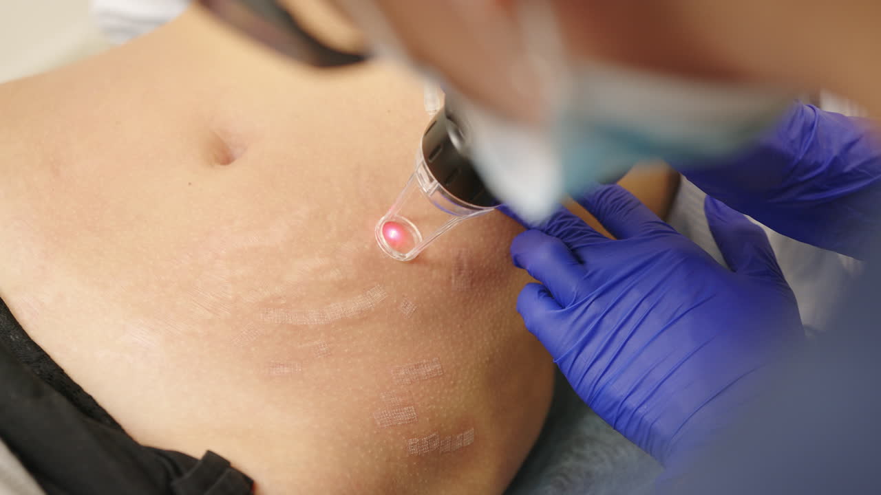 tratamiento con láser para las estrías