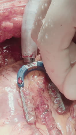la mano del cirujano fija los vasos de injerto. la cavidad torácica se abre con retractores para un trabajo cuidadoso en la arteria coronaria pequeña para desviar el suministro de sangre de cerca