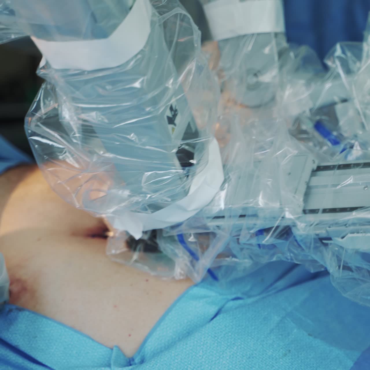 Modern medical robot in surgery. Complicated operation on a patient by robotic technology. Operating process with robotic equipment in clinic. Close-up.