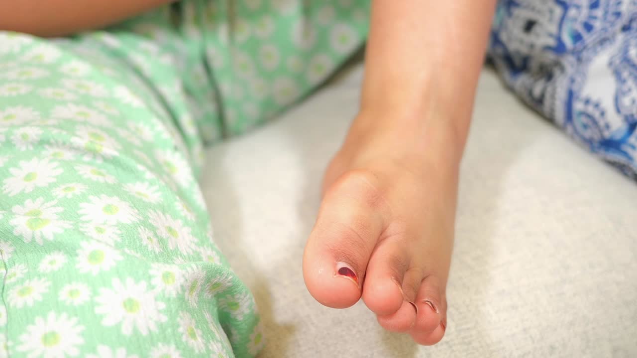 Close-up of a child's foot with a minor toe injury