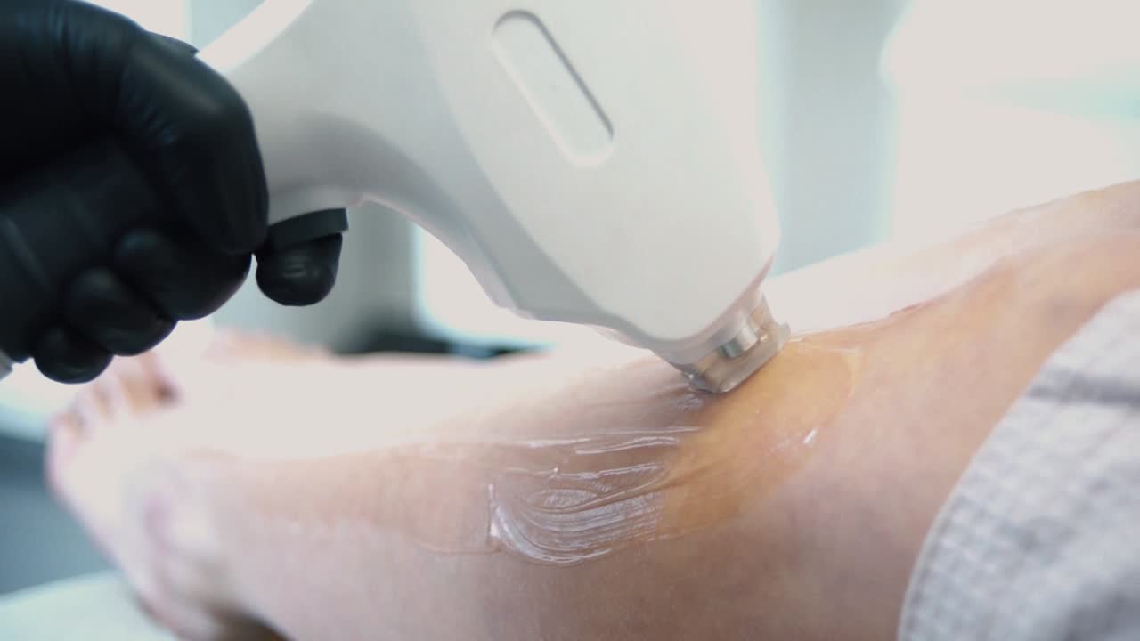 Laser Hair Removal Procedure on Leg