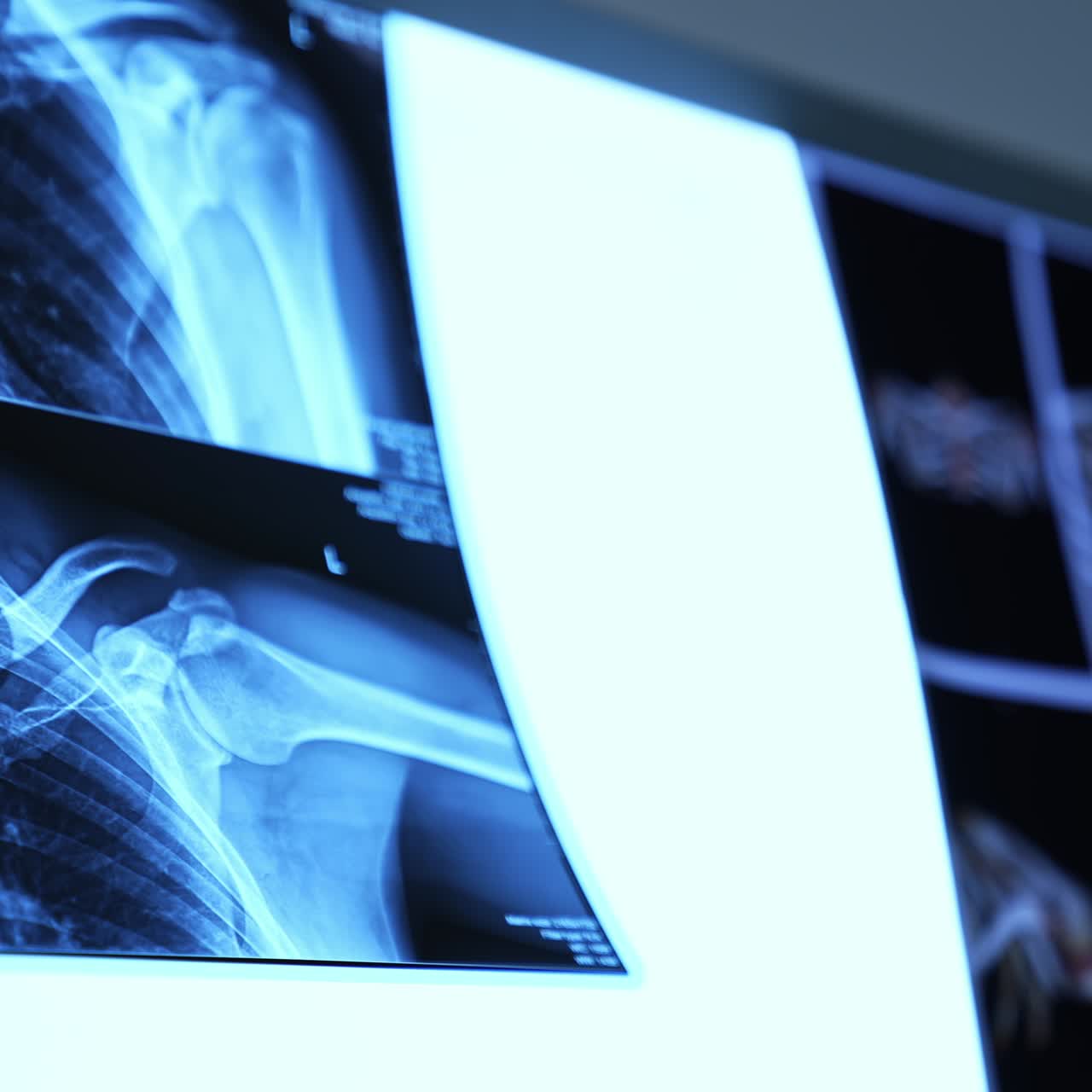 X-ray shots of human chest and shoulder hanging on a special screen. Equipment in the modern hospital. Close up