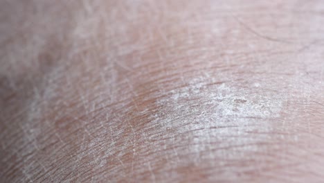 closeup of dry, flaky skin on a human arm