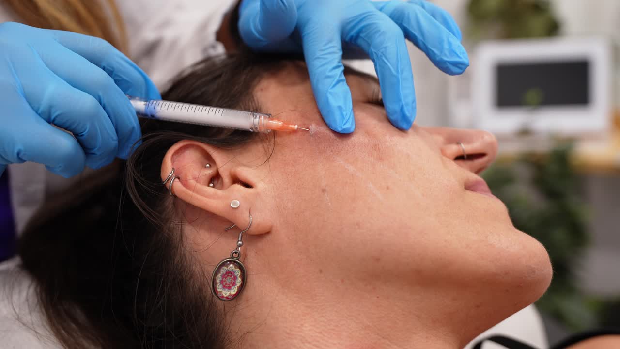 Procedura di iniezione di filler dermici