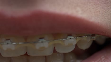 bracket system in smiling mouth, macro photo on white teeth with orthodontic braces