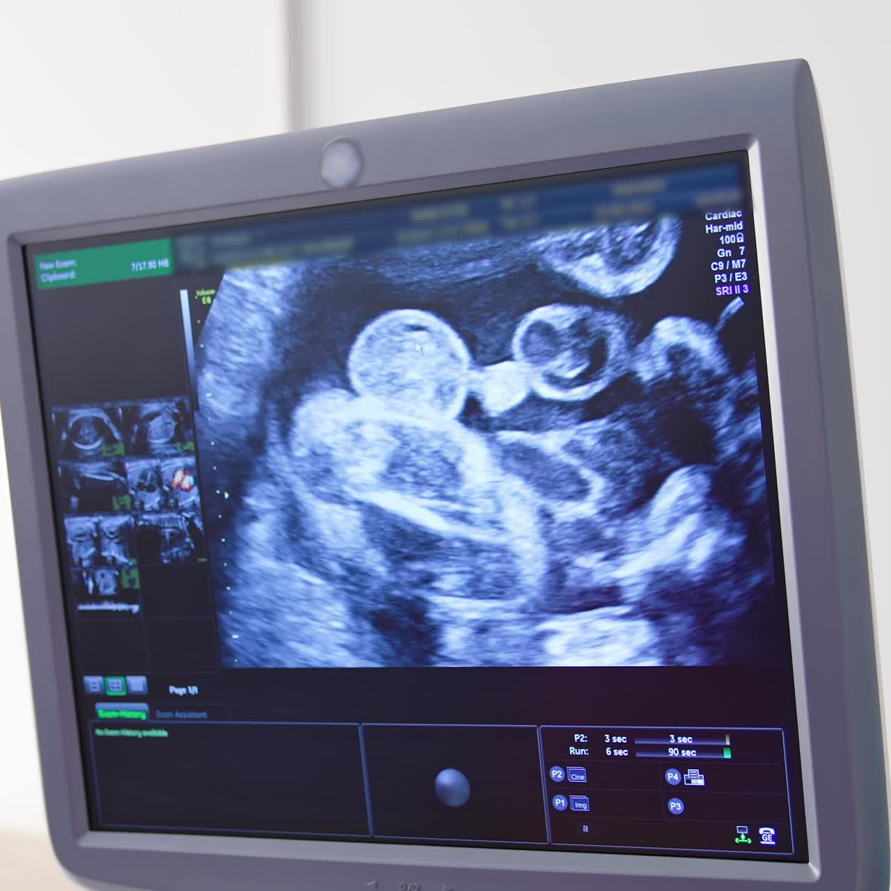 Monitor de ultrassom exibe um pequeno bebê. Imagem panorâmica de uma máquina de ultrassom moderna com a imagem de um futuro bebê na tela. Desenvolvimento da gravidez