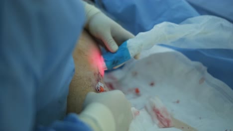 leg ulcer wound in treatment for varicose veins in phlebology procedure. bonding of veins using bioglue