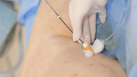iv procedimiento de inserción