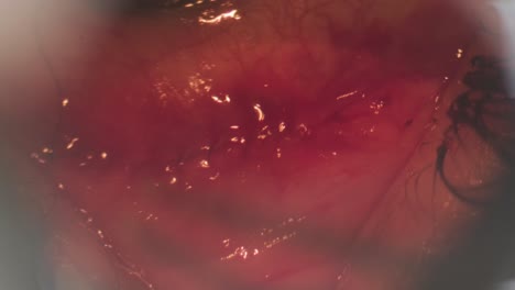 cirugía para corregir el estrabismo. vista a través de un microscopio. el cirujano cose el ojo. cirugía oftalmológica