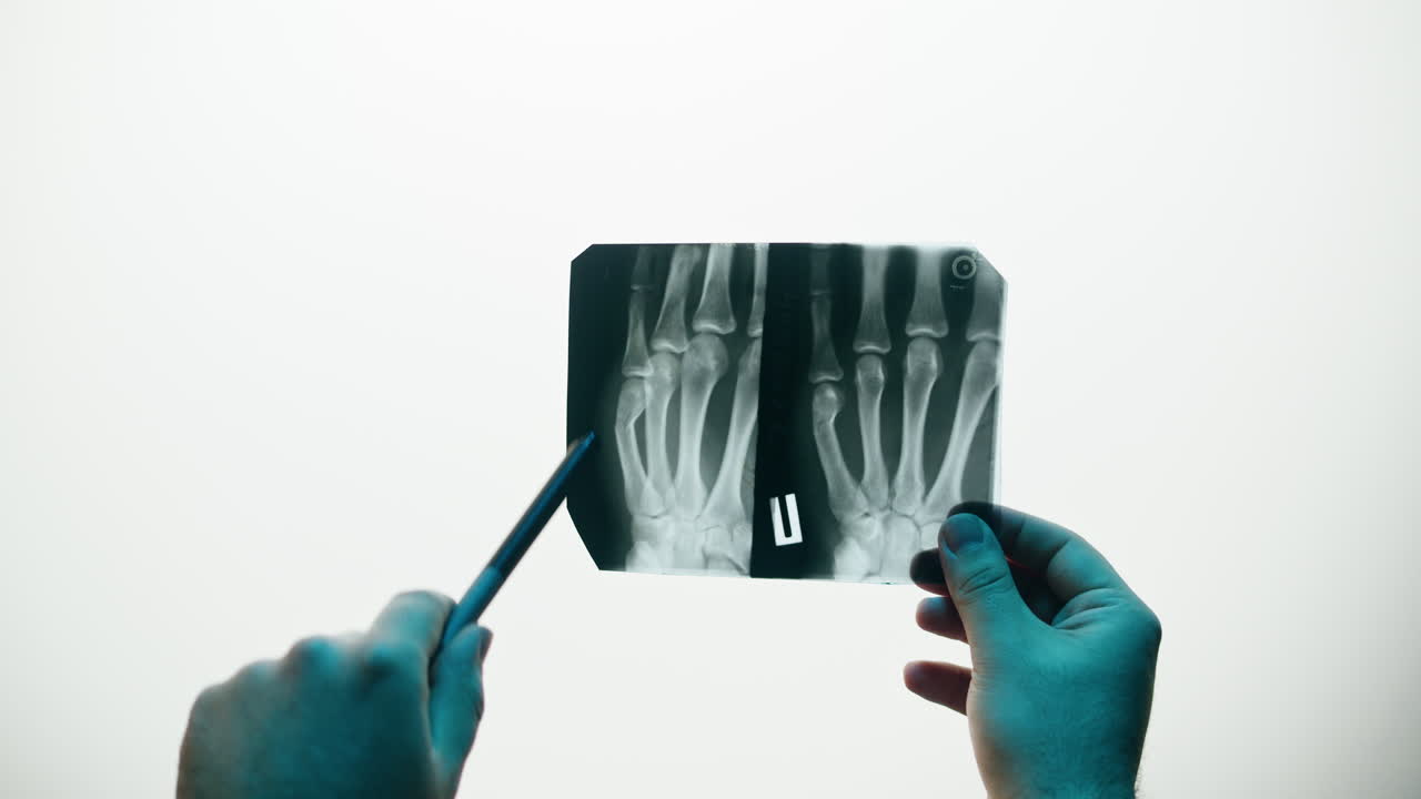 Doctor Examining Hand X-ray Film with Pen