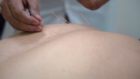 acupuncture treatment session