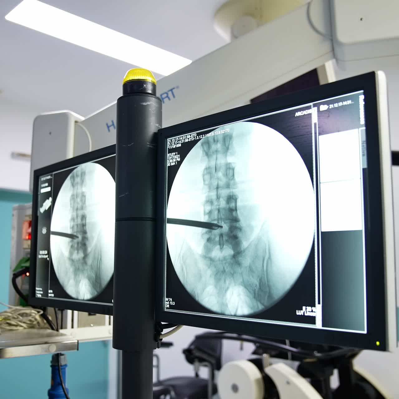 Two connected black-and-white screens in a modern surgery room. Monitor with the x-ray pictures of patient's spine