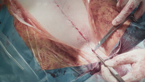 doctor hands make sutures after surgery. careful surgeon closes chest incision after successful coronary artery bypass surgery in hospital closeup