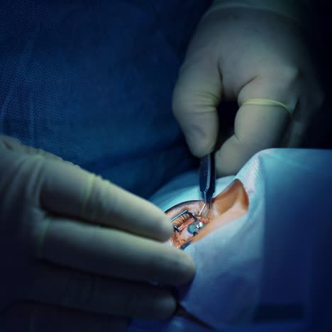 laser vision correction surgery. surgeon operating eye of patient at the operating room