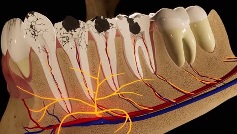 los dientes molares dañados por la caries. animación 3d del diente médicamente precisa