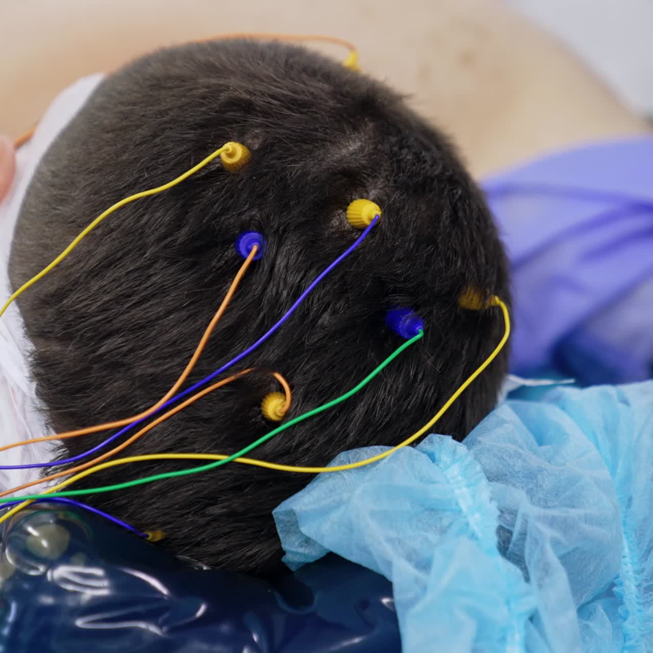 Little electrodes connected to patient's head. Close up. Neuromonitoring in modern hospital