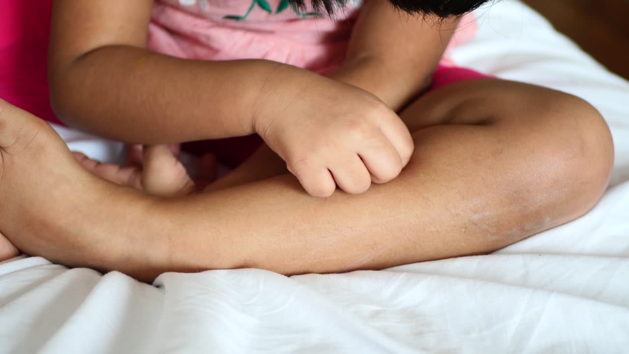 Child with skin rash on leg