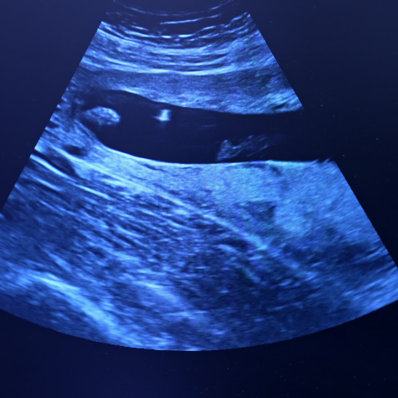 Ultrasonic image of female reproductive organs. Diagnostics of a patient before the extracorporeal insemination. Close up