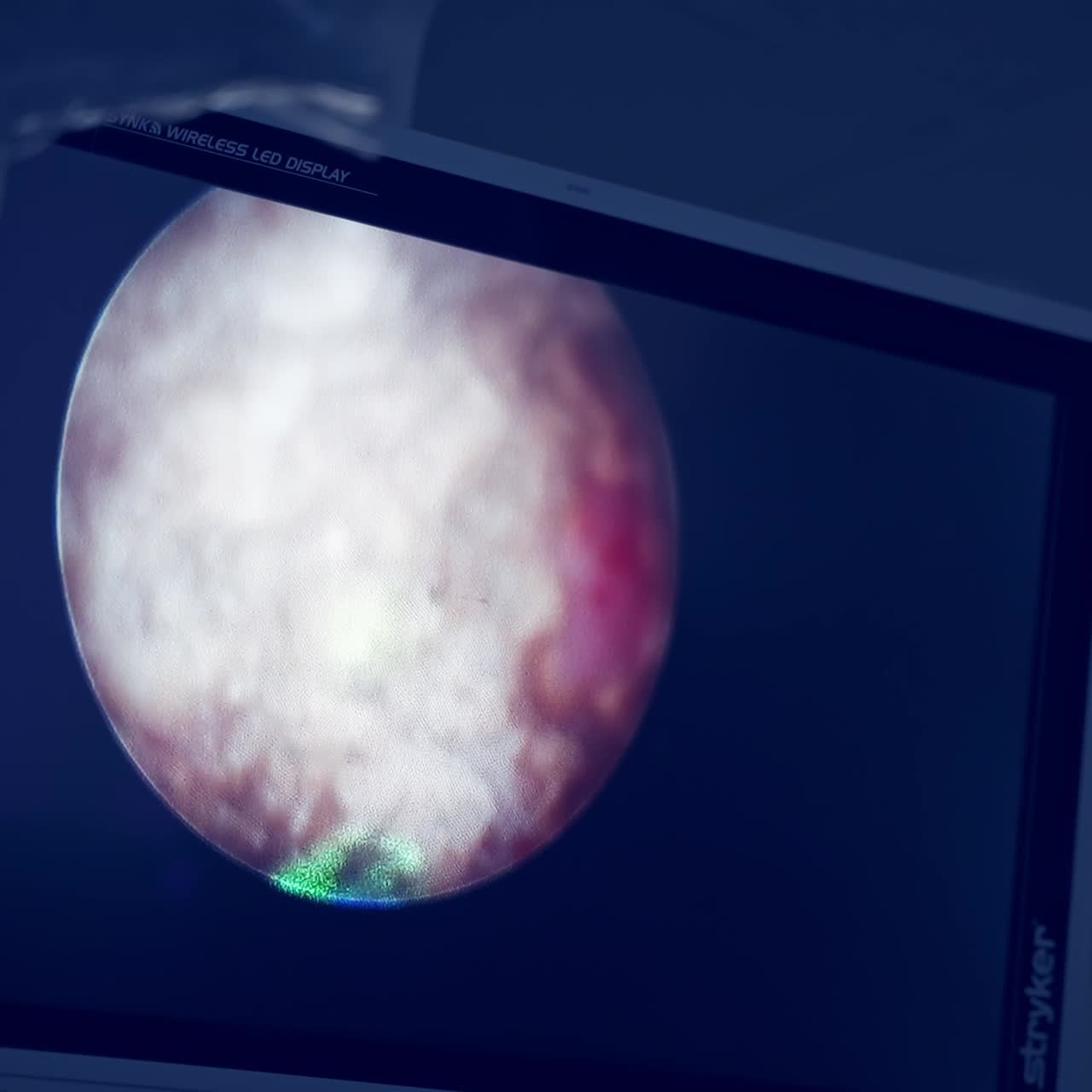 Medical team performing laparoscopy surgery. Surgeon operating patient, working with surgical laparoscopy instruments