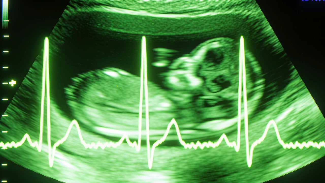 Ecografia che si aggiorna al secondo in clinica, con il feto che si muove leggermente e la traccia cardiaca ECG per il monitoraggio.