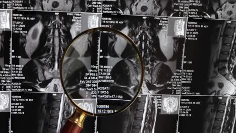 MRI-lumbar-spine-background,-magnetic-resonance-tomography.-Doctor-examines-MRI-of-lumbar-spine-with-pinched-discs-of-spine-and-nerves.