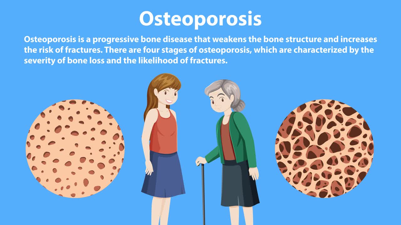 골다공증에서  밀도 손실의 단계