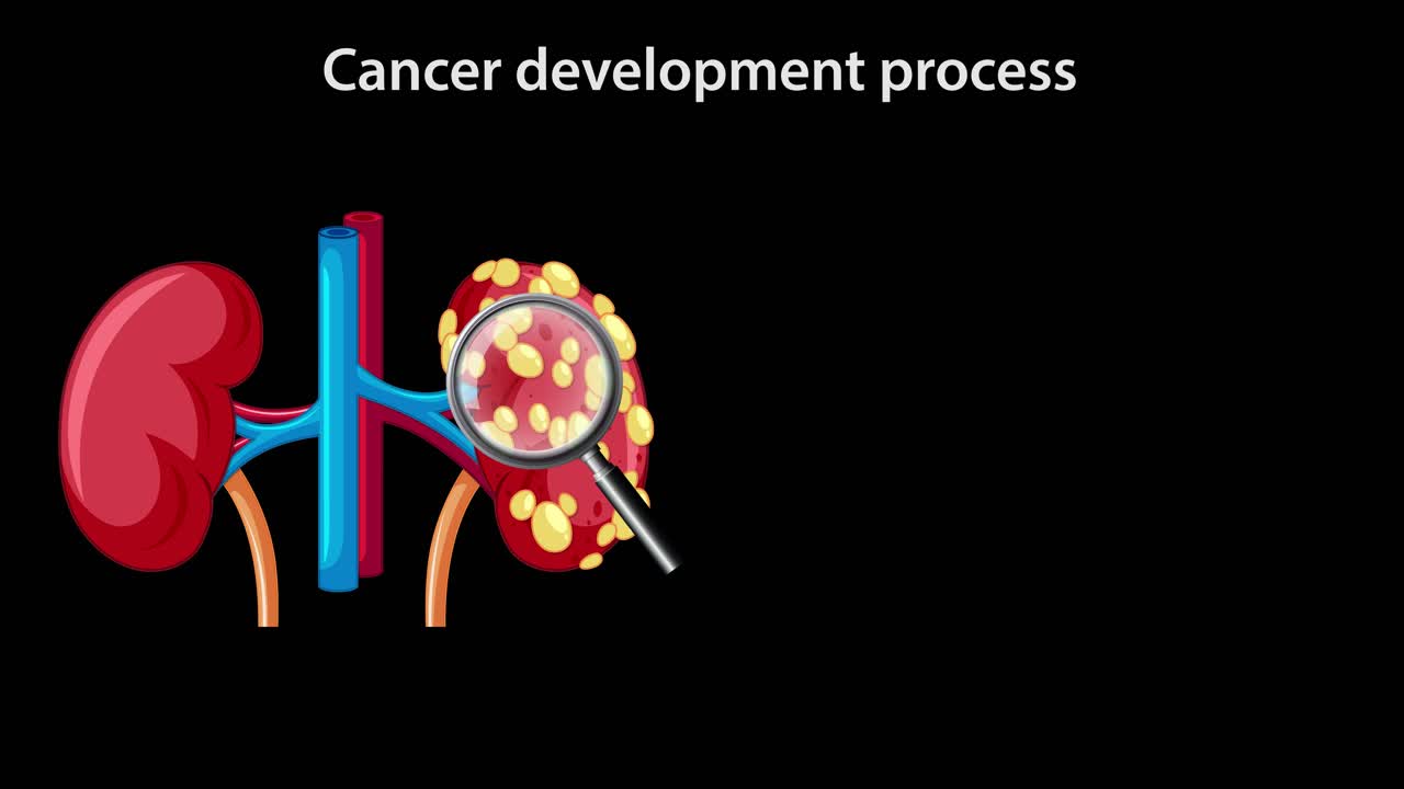 Medical animation illustrating kidney cancer progression, showing cellular transformation, tumor growth, and malignant cell multiplication with clear diagrams and smooth transitions