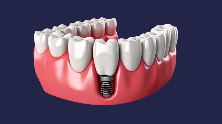 Dental implant model illustration animation isolated asset, transparent 4K video, alpha channel