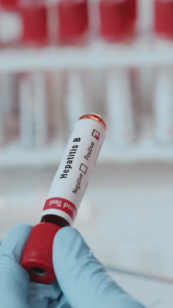 Healthcare professional prepares blood sample for hepatitis b testing in lab