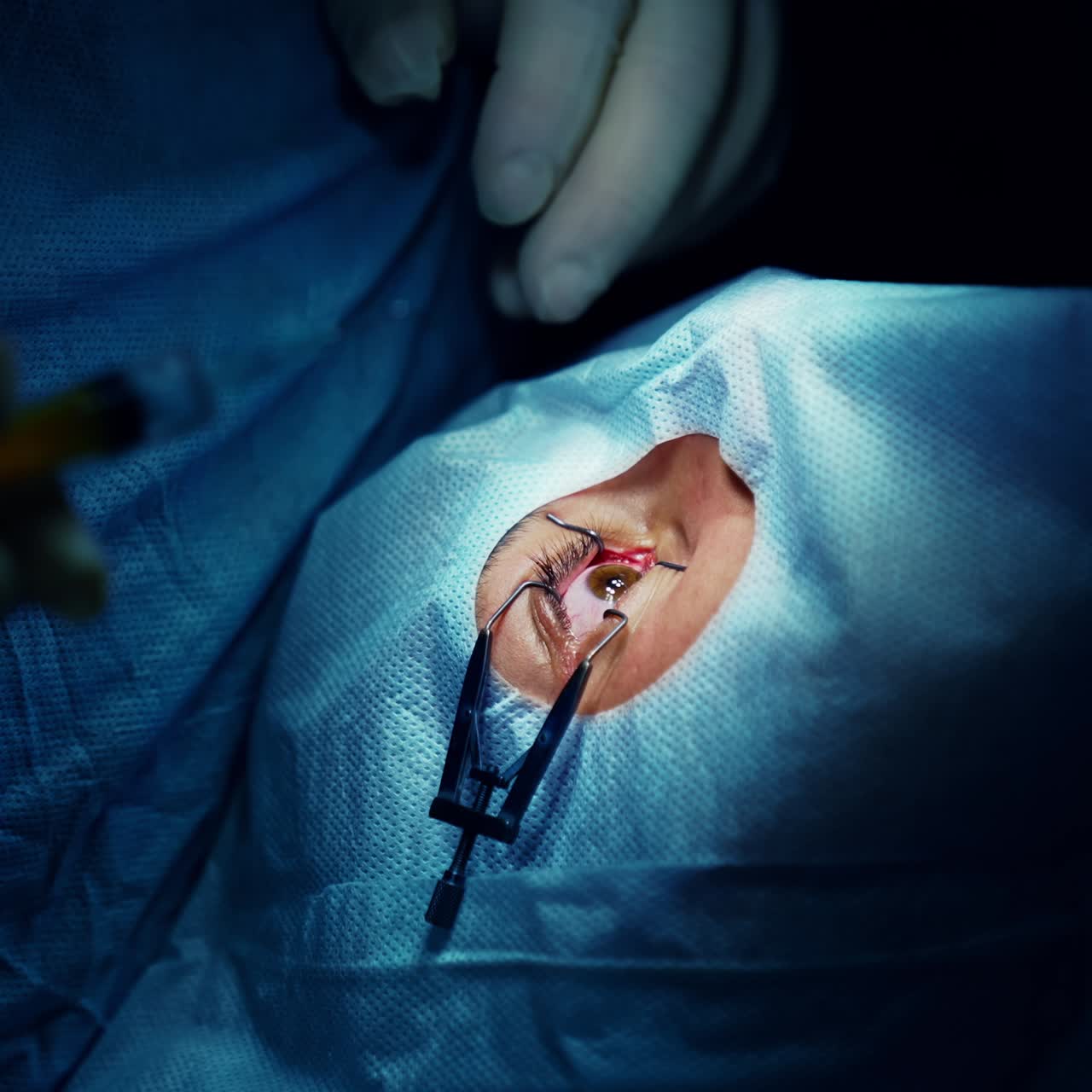 Operazione professionale di cataratta. Chirurgia moderna per la cura degli occhi
