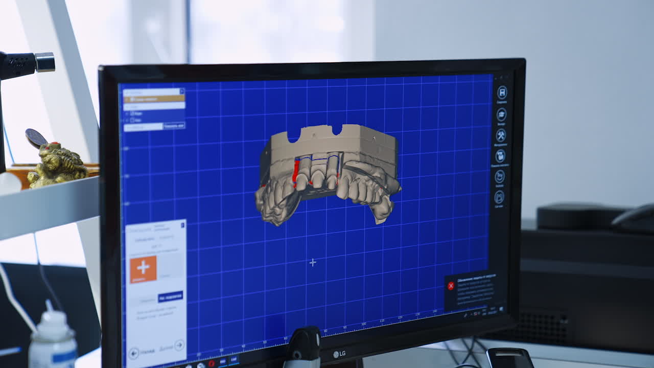 Computer screen with 3d denture scan. Preparation for front teeth implantation. Close up.