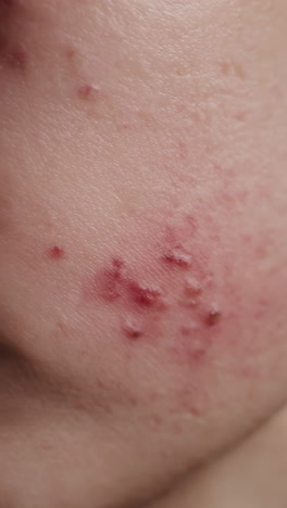 Acne on Face