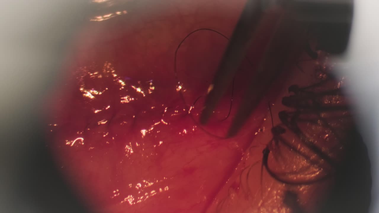 cirugía para corregir el estrabismo. vista a través de un microscopio. el cirujano cose el ojo. cirugía oftalmológica