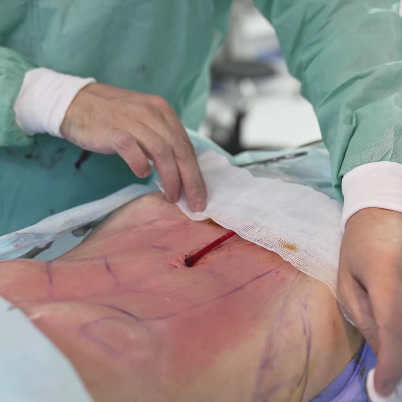 Patient's abdomen after liposuction procedure. Fat removal surgery. Plastic surgeon finishing the operation of liposuction and liposculpture. Patient's body during surgery