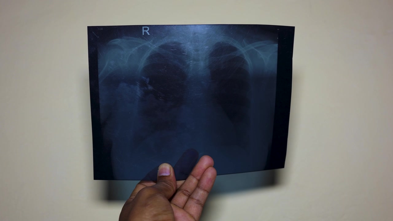 Medical Professional Examining Chest X Ray Film For Respiratory Health Evaluation