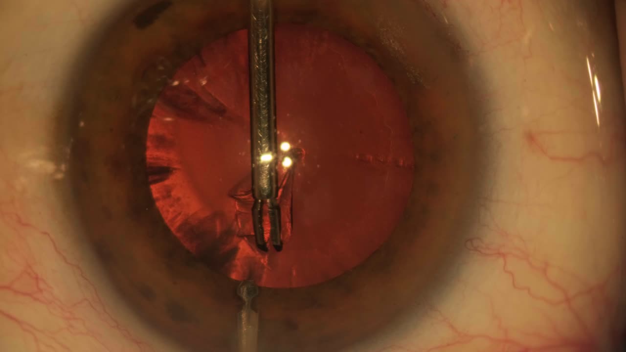 cirugía ocular, vitreoretinal, cirugía de vitrectomía.