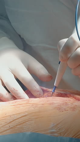 el médico hace una incisión profunda en el pecho del paciente de cerca. el cirujano de cardiología utiliza un bisturí láser caliente para la cirugía de derivación de la arteria coronaria en el hospital