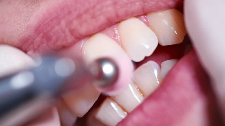 Dental Cleaning Procedure