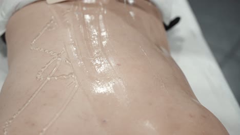 gel application for laser hair removal on man's back