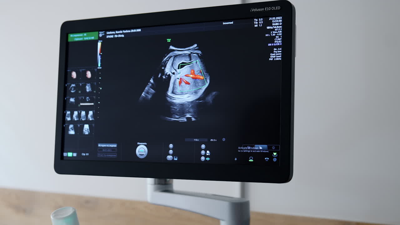 Monitor of ultrasound machine during the pregnancy check up. Close up. Examining the fetus development in hospital.
