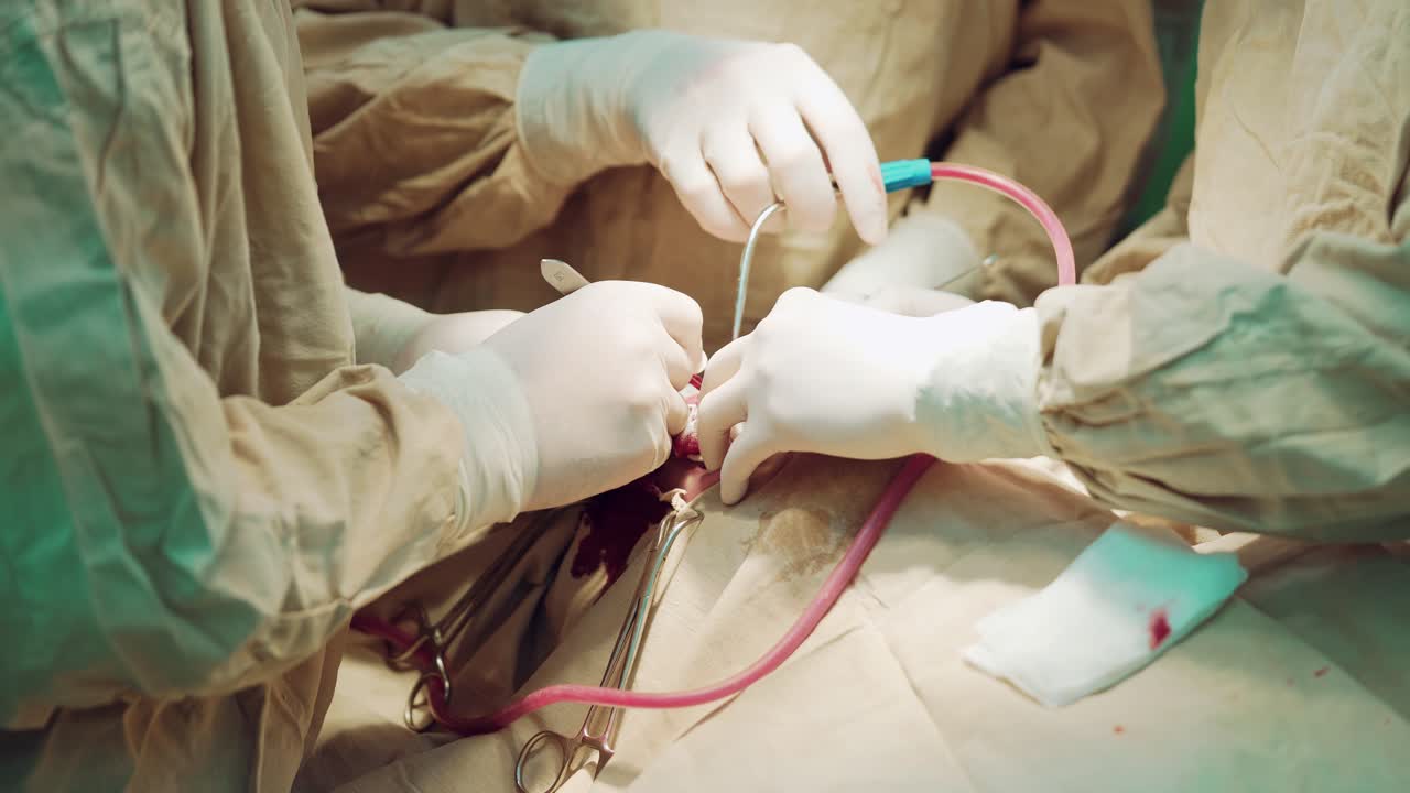 In surgery. Medical team performing operation in hospital operating theater. Working with surgical instruments.